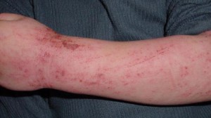 370655_Atopic-dermatitis